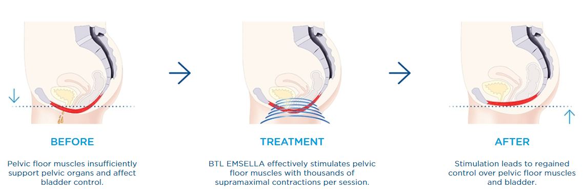 Before, during and after Emsella treatment information