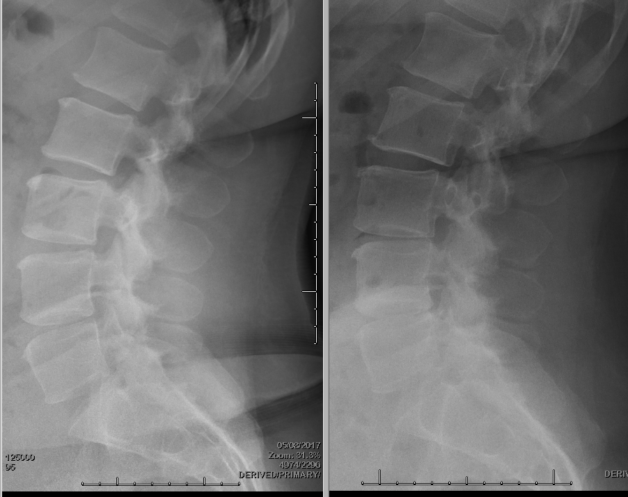 Before and after core improvement results