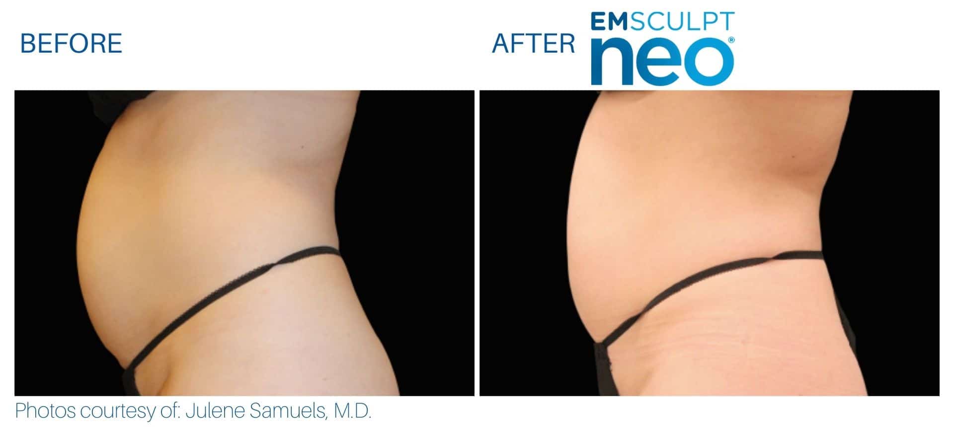Can EMSCULPT Treat Other Body Areas Besides Abs?