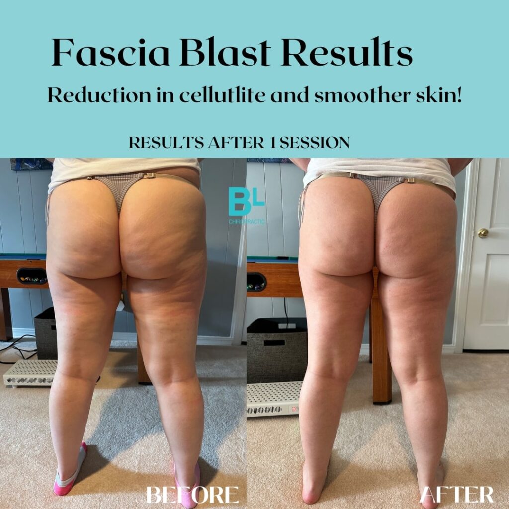 Before and after fascia blast results